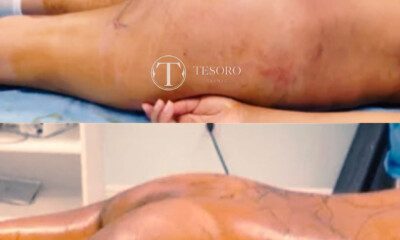 zabieg-lipomodellingu-posladkow