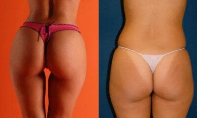 lipomodelling-posladkow-tesoro-clinic