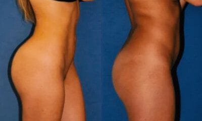 powiekszanie-posladkow-wroclaw