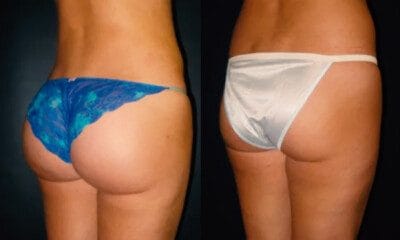 zabieg-powiekszania-posladkow-wroclaw